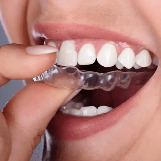 Clear Aligners Invisalign Treatment Miami